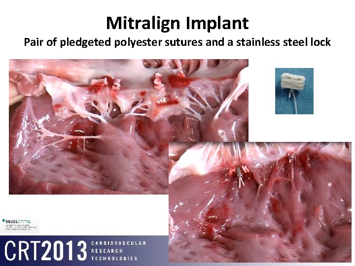 Mitralign Implant Pair of pledgeted polyester sutures and a stainless steel lock 