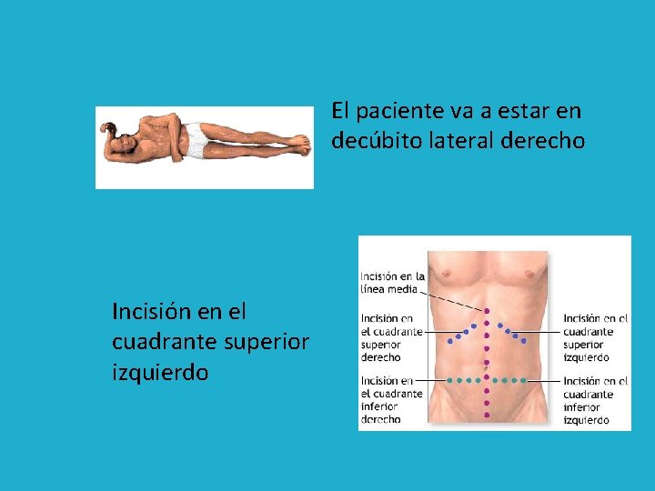 El paciente va a estar en decúbito lateral derecho Incisión en el cuadrante superior