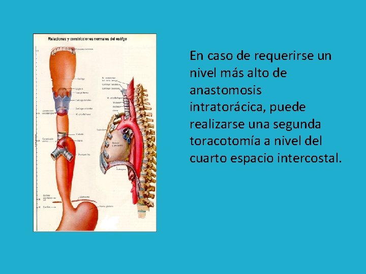 En caso de requerirse un nivel más alto de anastomosis intratorácica, puede realizarse una