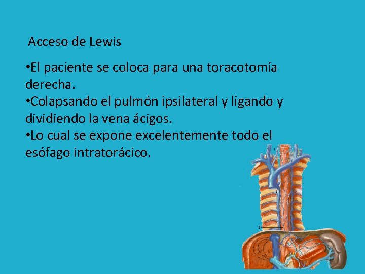 Acceso de Lewis • El paciente se coloca para una toracotomía derecha. • Colapsando