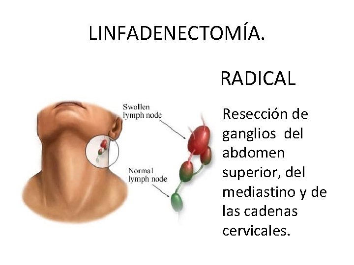 LINFADENECTOMÍA. RADICAL Resección de ganglios del abdomen superior, del mediastino y de las cadenas