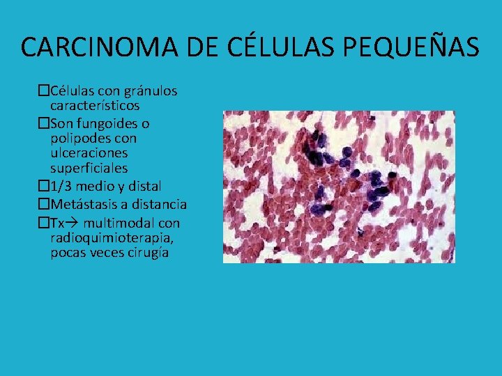 CARCINOMA DE CÉLULAS PEQUEÑAS �Células con gránulos característicos �Son fungoides o polipodes con ulceraciones