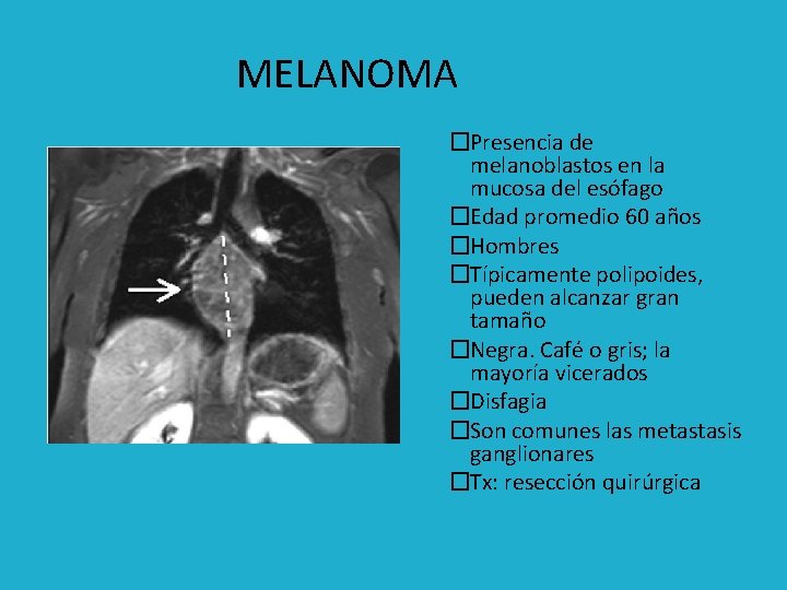 MELANOMA �Presencia de melanoblastos en la mucosa del esófago �Edad promedio 60 años �Hombres