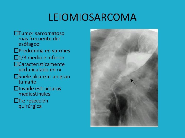 LEIOMIOSARCOMA �Tumor sarcomatoso más frecuente del esófagoo �Predomina en varones � 1/3 medio e