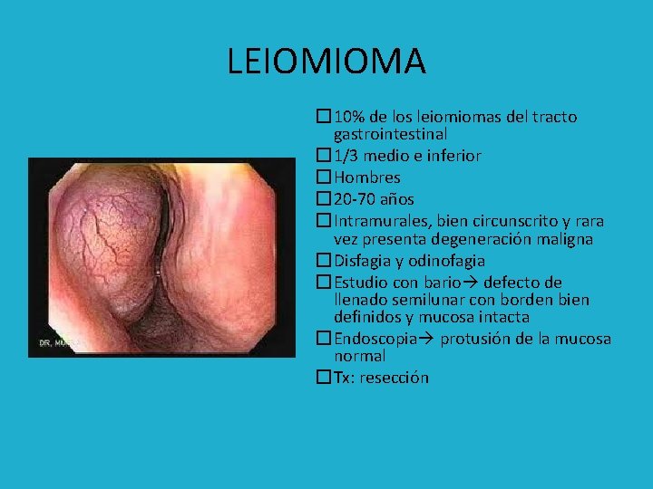 LEIOMIOMA � 10% de los leiomiomas del tracto gastrointestinal � 1/3 medio e inferior