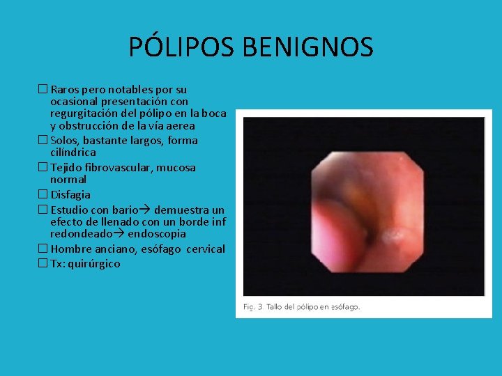 PÓLIPOS BENIGNOS � Raros pero notables por su ocasional presentación con regurgitación del pólipo