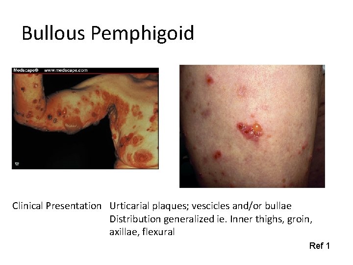 Bullous Pemphigoid Clinical Presentation Urticarial plaques; vescicles and/or bullae Distribution generalized ie. Inner thighs,