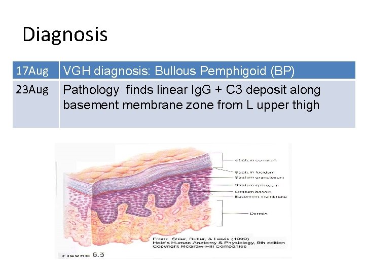 Diagnosis 17 Aug 23 Aug VGH diagnosis: Bullous Pemphigoid (BP) Pathology finds linear Ig.