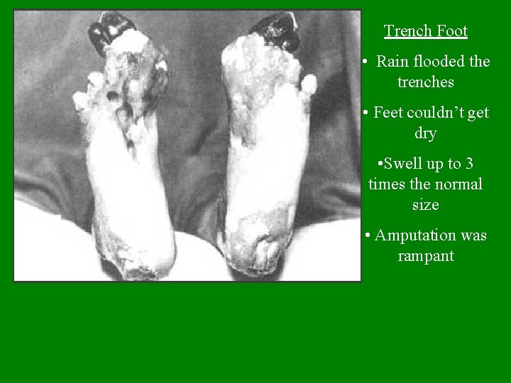 Trench Foot • Rain flooded the trenches • Feet couldn’t get dry • Swell