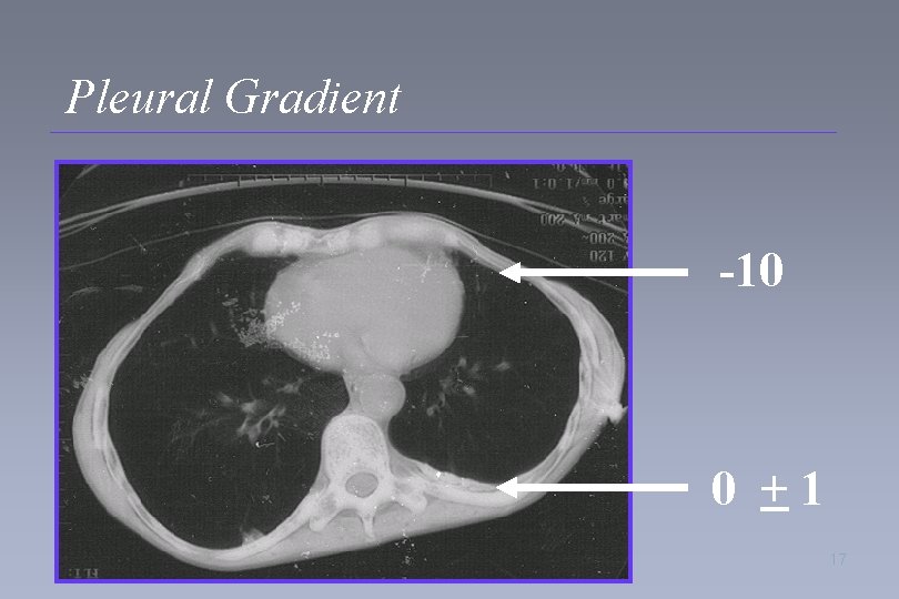 Pleural Gradient -10 0 +1 17 