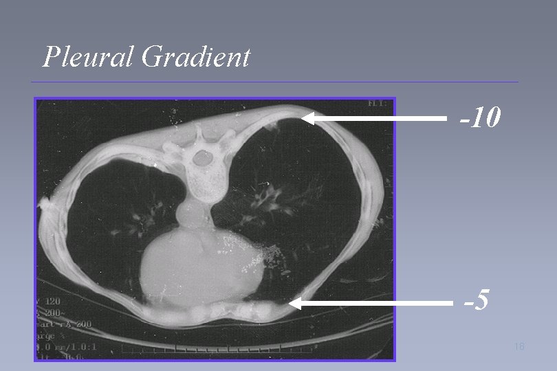 Pleural Gradient -10 -5 18 