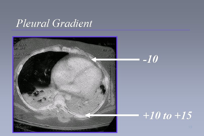 Pleural Gradient -10 +10 to +15 19 