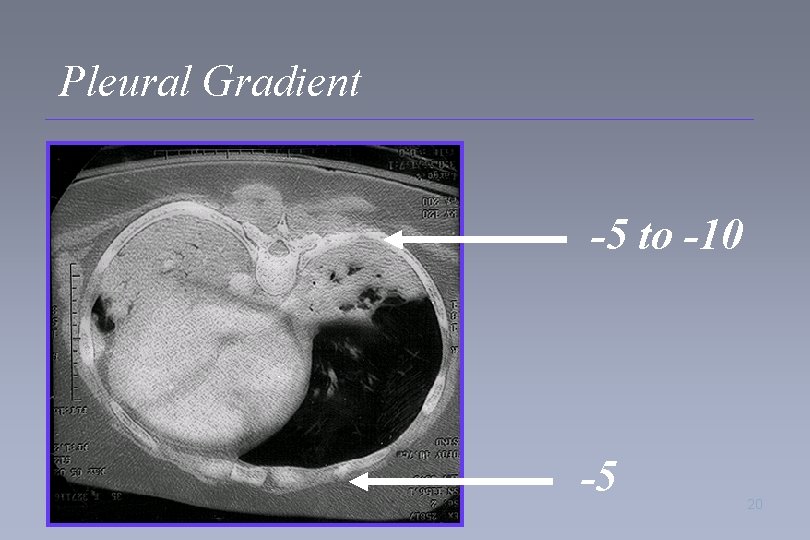 Pleural Gradient -5 to -10 -5 20 