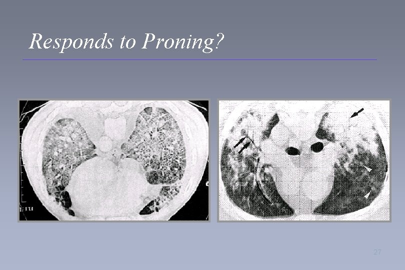 Responds to Proning? 27 