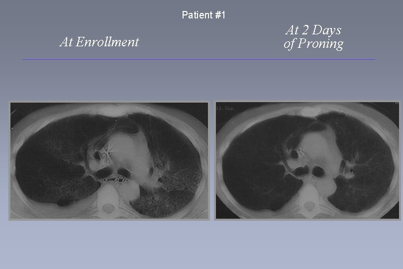 Patient #1 At Enrollment At 2 Days of Proning 