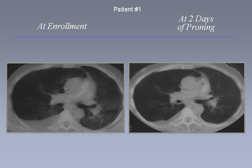 Patient #1 At Enrollment At 2 Days of Proning 