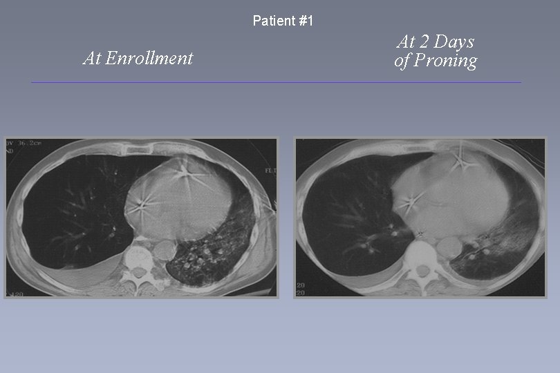 Patient #1 At Enrollment At 2 Days of Proning 