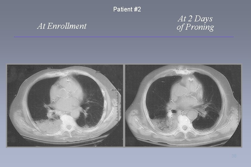Patient #2 At Enrollment At 2 Days of Proning 38 