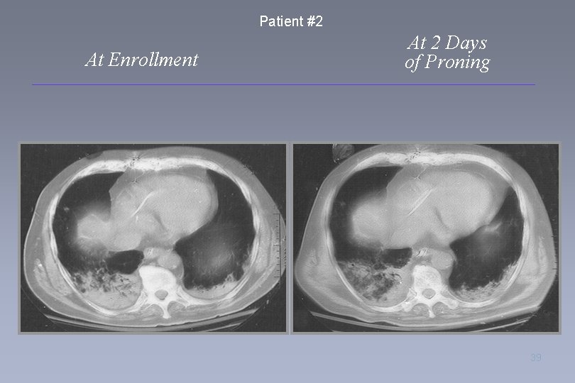 Patient #2 At Enrollment At 2 Days of Proning 39 
