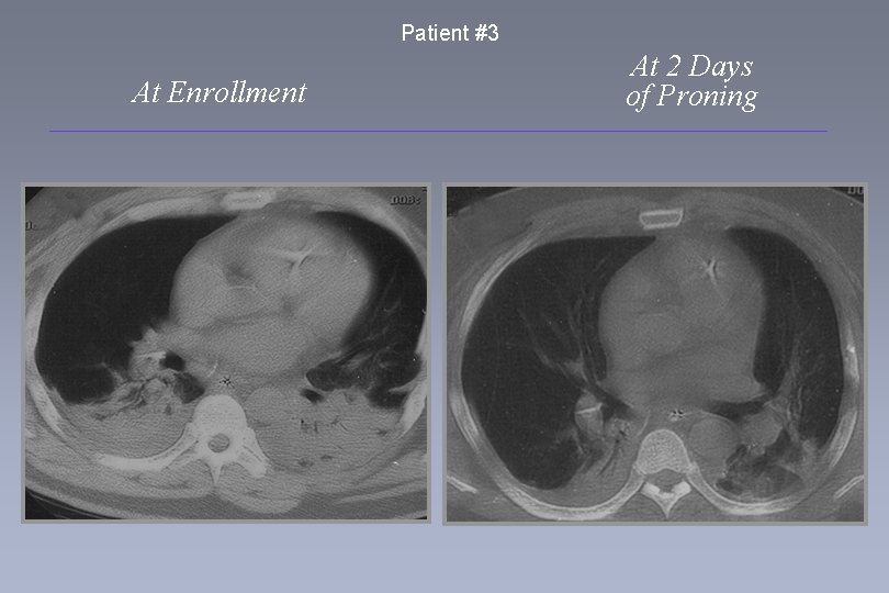 Patient #3 At Enrollment At 2 Days of Proning 