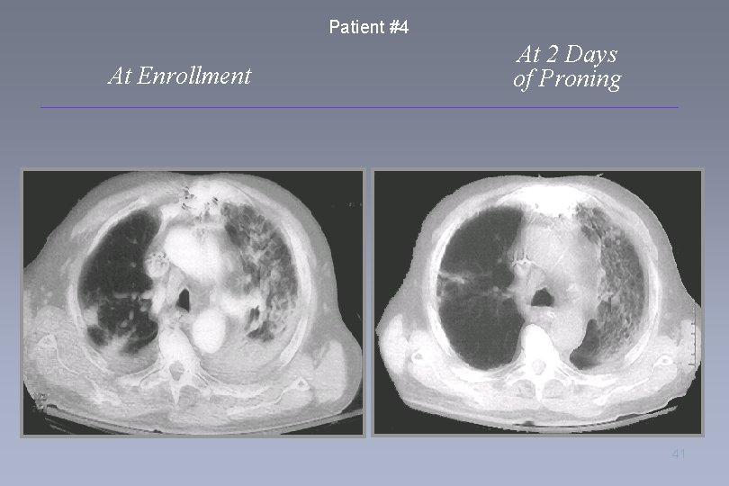 Patient #4 At Enrollment At 2 Days of Proning 41 