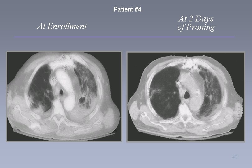 Patient #4 At Enrollment At 2 Days of Proning 42 