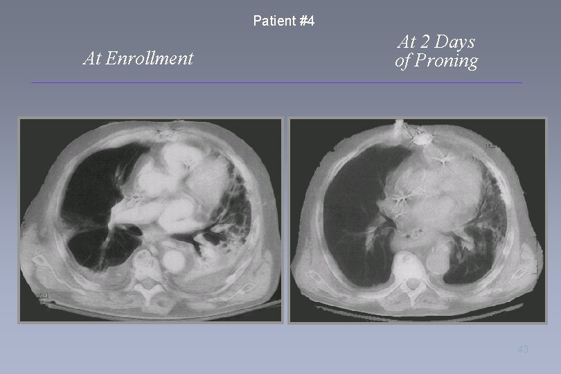 Patient #4 At Enrollment At 2 Days of Proning 43 