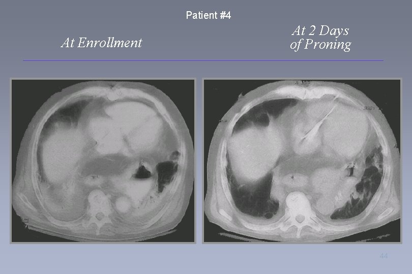 Patient #4 At Enrollment At 2 Days of Proning 44 