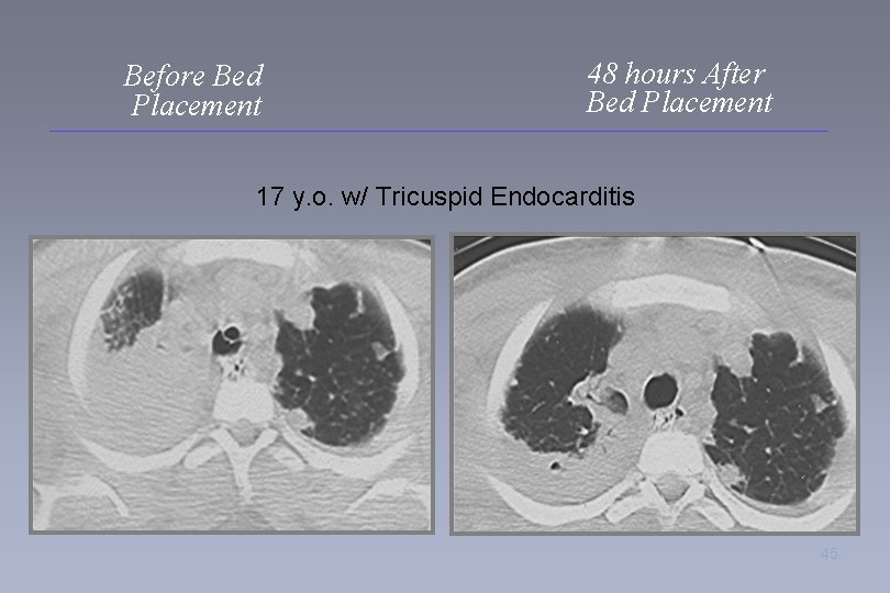 Before Bed Placement 48 hours After Bed Placement 17 y. o. w/ Tricuspid Endocarditis