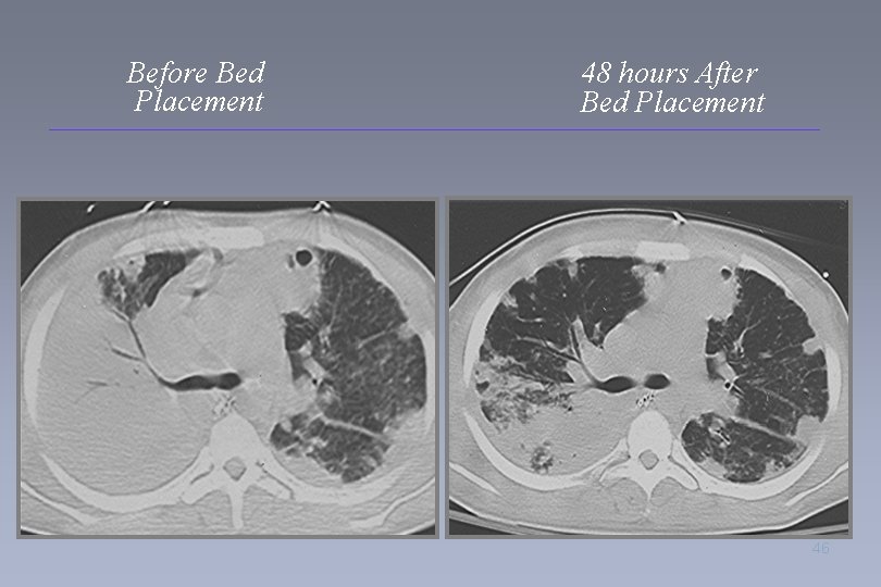 Before Bed Placement 48 hours After Bed Placement 46 