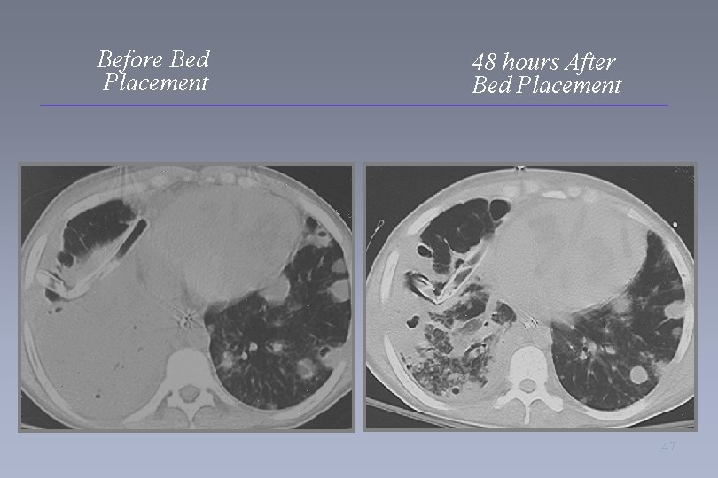 Before Bed Placement 48 hours After Bed Placement 47 