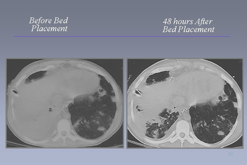Before Bed Placement 48 hours After Bed Placement 48 