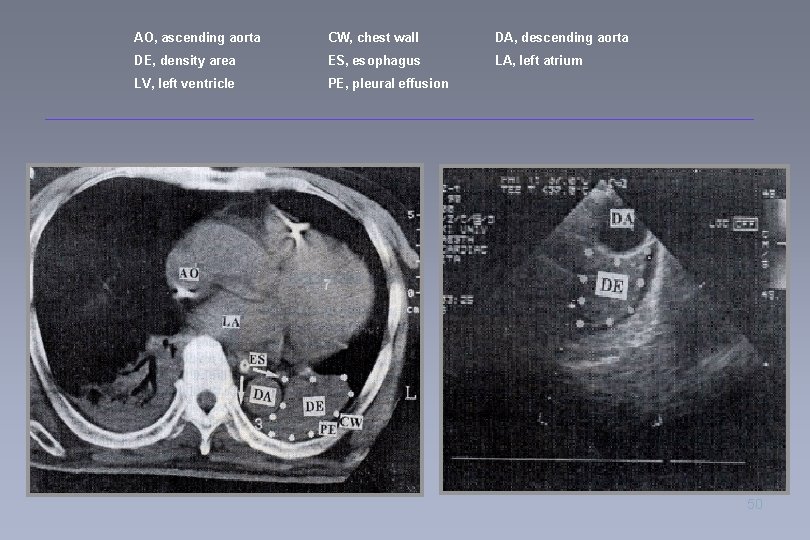 AO, ascending aorta CW, chest wall DA, descending aorta DE, density area ES, esophagus