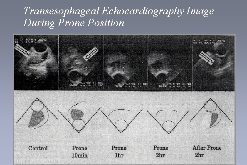 Transesophageal Echocardiography Image During Prone Position 51 