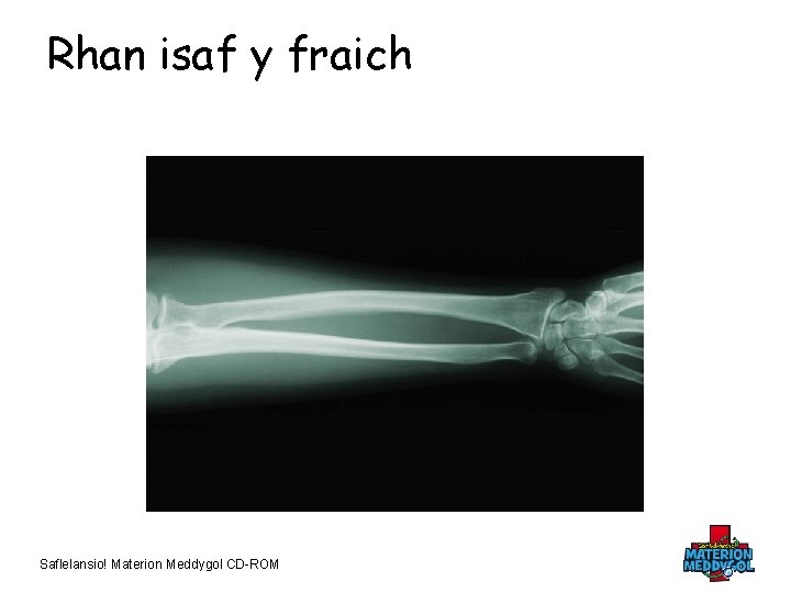 Rhan isaf y fraich Saflelansio! Materion Meddygol CD-ROM 