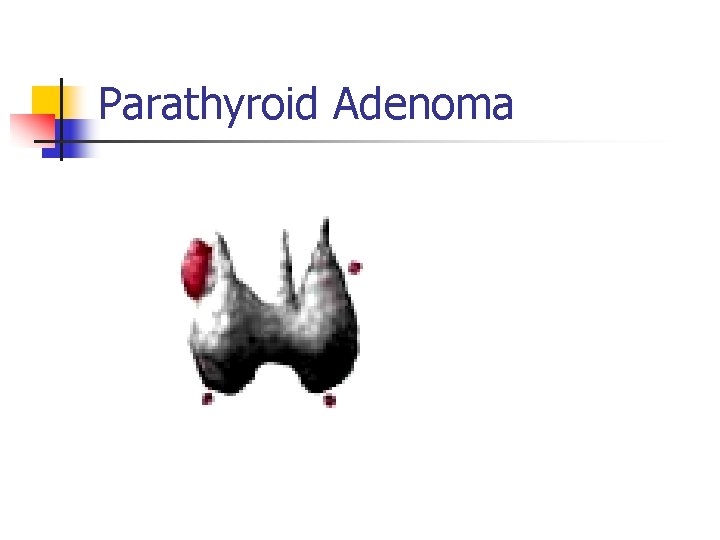 Parathyroid Adenoma 