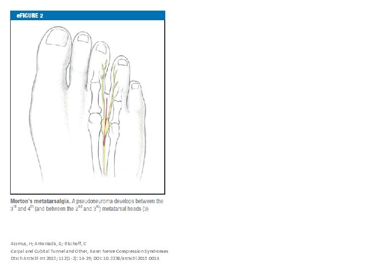 Assmus, H; Antoniadis, G; Bischoff, C Carpal and Cubital Tunnel and Other, Rarer Nerve