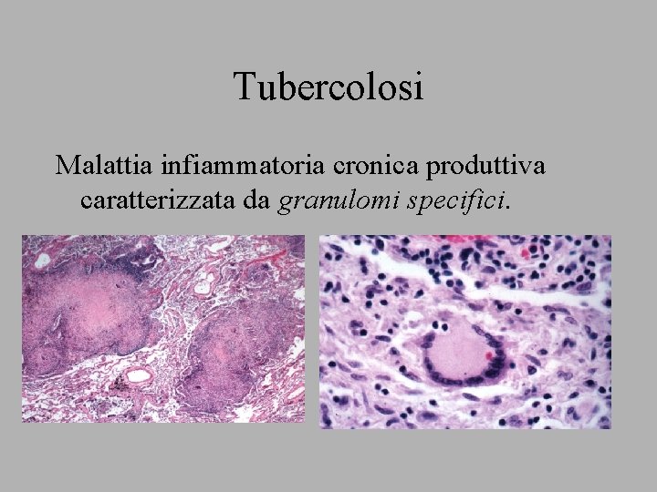 Tubercolosi Malattia infiammatoria cronica produttiva caratterizzata da granulomi specifici. 