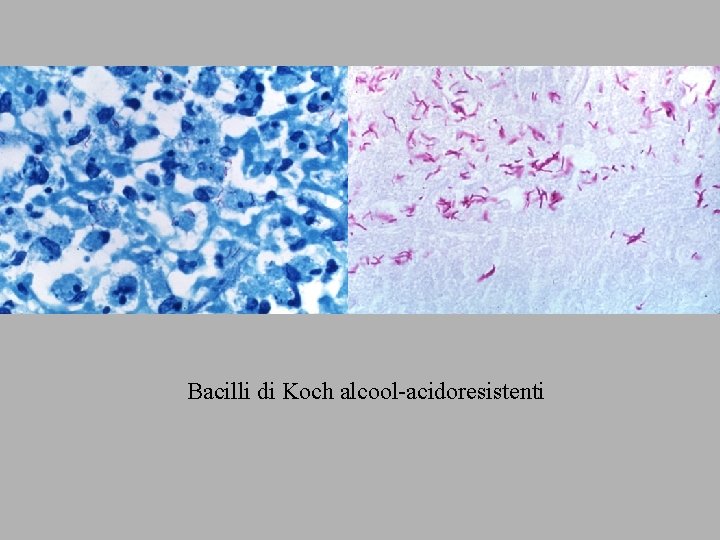 Bacilli di Koch alcool-acidoresistenti 