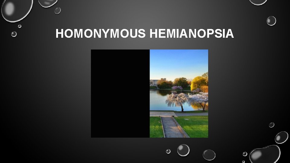 HOMONYMOUS HEMIANOPSIA 