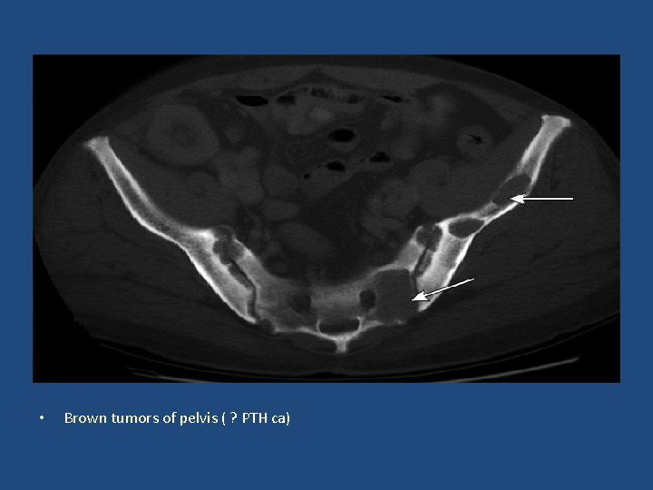  • Brown tumors of pelvis ( ? PTH ca) 