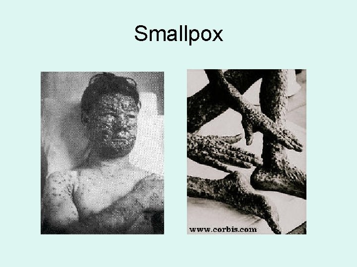 Smallpox 