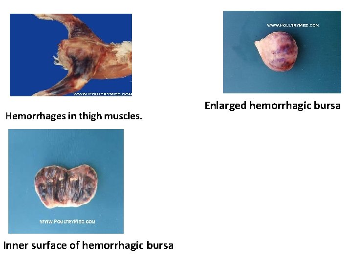 Hemorrhages in thigh muscles. Inner surface of hemorrhagic bursa Enlarged hemorrhagic bursa 