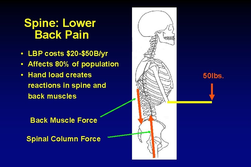 Spine: Lower Back Pain • LBP costs $20 -$50 B/yr • Affects 80% of