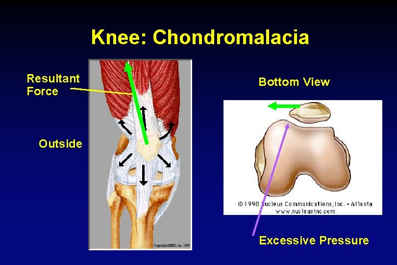Knee: Chondromalacia Resultant Force Bottom View Outside Excessive Pressure 