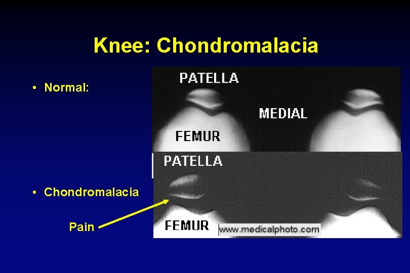 Knee: Chondromalacia • Normal: • Chondromalacia Pain 