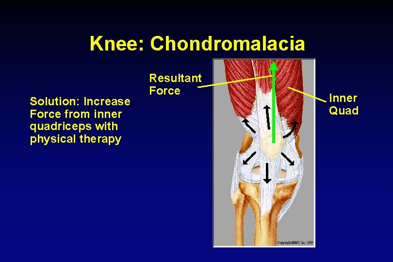 Knee: Chondromalacia Solution: Increase Force from inner quadriceps with physical therapy Resultant Force Inner