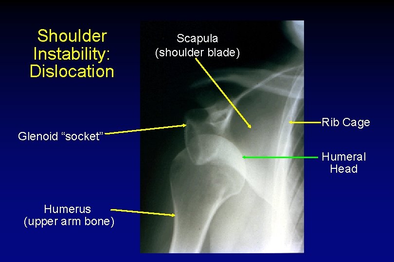 Shoulder Instability: Dislocation Scapula (shoulder blade) Rib Cage Glenoid “socket” Humeral Head Humerus (upper
