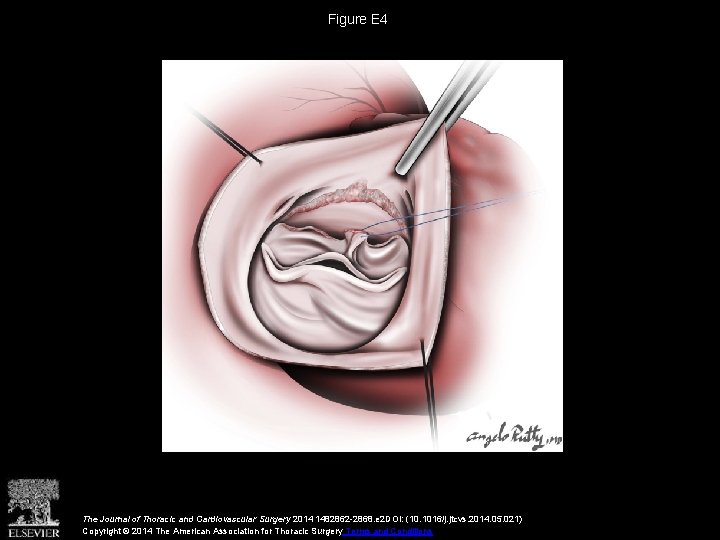 Figure E 4 The Journal of Thoracic and Cardiovascular Surgery 2014 1482862 -2868. e