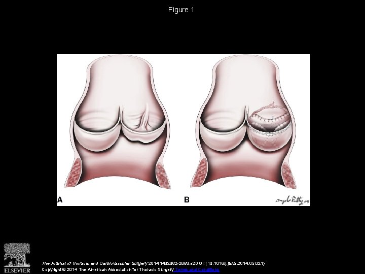 Figure 1 The Journal of Thoracic and Cardiovascular Surgery 2014 1482862 -2868. e 2